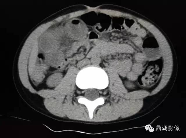 【病例】美克尔憩室(Meckels diverticulum) 一例影像诊断 【病例】美克尔憩室(Meckels diverticulum) 一例影像诊断