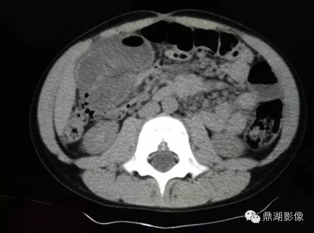 【病例】美克尔憩室(Meckels diverticulum) 一例影像诊断 【病例】美克尔憩室(Meckels diverticulum) 一例影像诊断