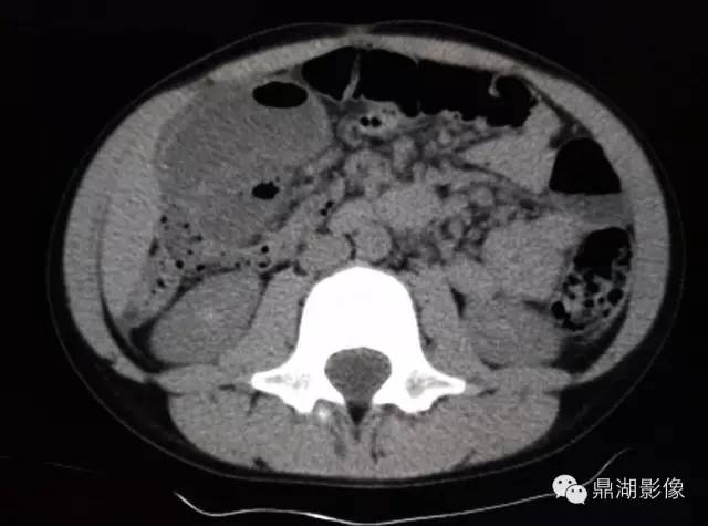 【病例】美克尔憩室(Meckels diverticulum) 一例影像诊断 【病例】美克尔憩室(Meckels diverticulum) 一例影像诊断