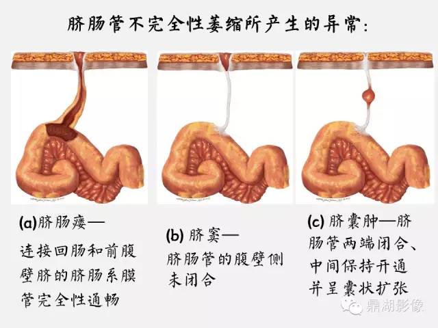 【病例】美克尔憩室(Meckels diverticulum) 一例影像诊断 【病例】美克尔憩室(Meckels diverticulum) 一例影像诊断