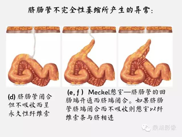 【病例】美克尔憩室(Meckels diverticulum) 一例影像诊断 【病例】美克尔憩室(Meckels diverticulum) 一例影像诊断
