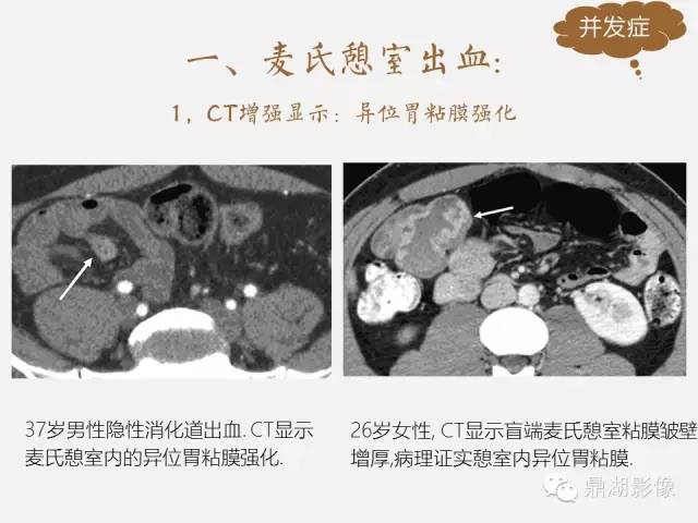 【病例】美克尔憩室(Meckels diverticulum) 一例影像诊断 【病例】美克尔憩室(Meckels diverticulum) 一例影像诊断