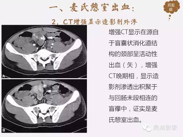 【病例】美克尔憩室(Meckels diverticulum) 一例影像诊断 【病例】美克尔憩室(Meckels diverticulum) 一例影像诊断