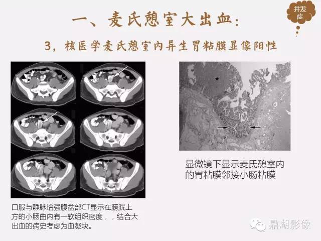 【病例】美克尔憩室(Meckels diverticulum) 一例影像诊断 【病例】美克尔憩室(Meckels diverticulum) 一例影像诊断