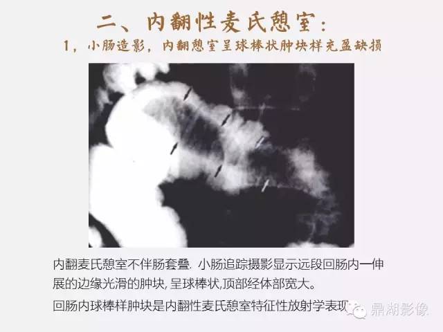 【病例】美克尔憩室(Meckels diverticulum) 一例影像诊断 【病例】美克尔憩室(Meckels diverticulum) 一例影像诊断