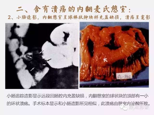 【病例】美克尔憩室(Meckels diverticulum) 一例影像诊断 【病例】美克尔憩室(Meckels diverticulum) 一例影像诊断