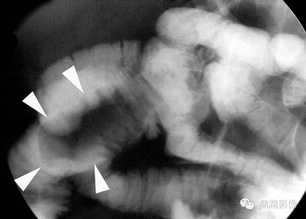【病例】美克尔憩室(Meckels diverticulum) 一例影像诊断 【病例】美克尔憩室(Meckels diverticulum) 一例影像诊断