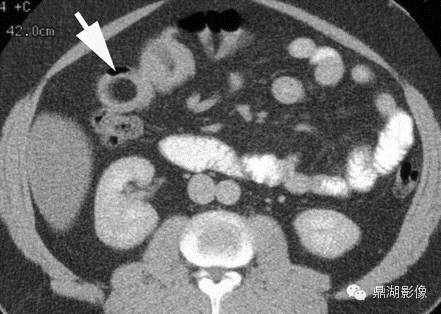 【病例】美克尔憩室(Meckels diverticulum) 一例影像诊断 【病例】美克尔憩室(Meckels diverticulum) 一例影像诊断