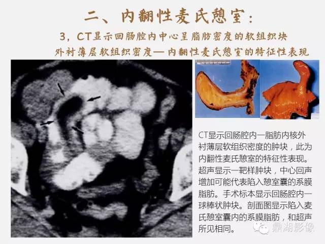 【病例】美克尔憩室(Meckels diverticulum) 一例影像诊断 【病例】美克尔憩室(Meckels diverticulum) 一例影像诊断