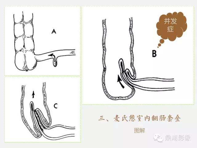 【病例】美克尔憩室(Meckels diverticulum) 一例影像诊断 【病例】美克尔憩室(Meckels diverticulum) 一例影像诊断