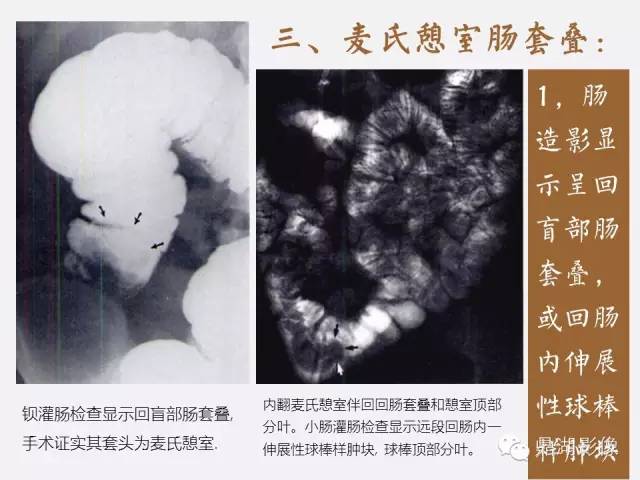 【病例】美克尔憩室(Meckels diverticulum) 一例影像诊断 【病例】美克尔憩室(Meckels diverticulum) 一例影像诊断