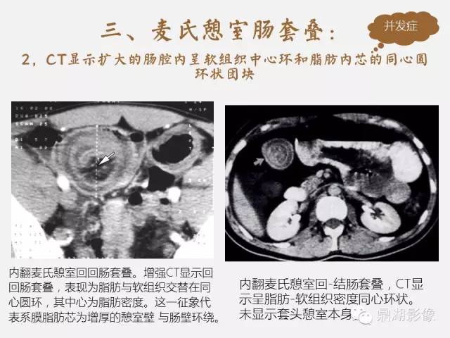 【病例】美克尔憩室(Meckels diverticulum) 一例影像诊断 【病例】美克尔憩室(Meckels diverticulum) 一例影像诊断