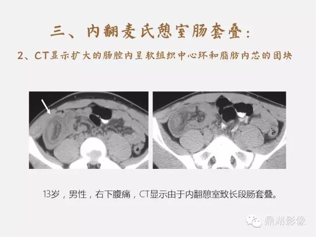 【病例】美克尔憩室(Meckels diverticulum) 一例影像诊断 【病例】美克尔憩室(Meckels diverticulum) 一例影像诊断