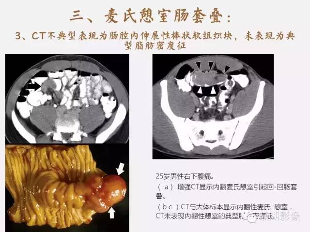 【病例】美克尔憩室(Meckels diverticulum) 一例影像诊断 【病例】美克尔憩室(Meckels diverticulum) 一例影像诊断