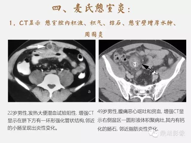 【病例】美克尔憩室(Meckels diverticulum) 一例影像诊断 【病例】美克尔憩室(Meckels diverticulum) 一例影像诊断