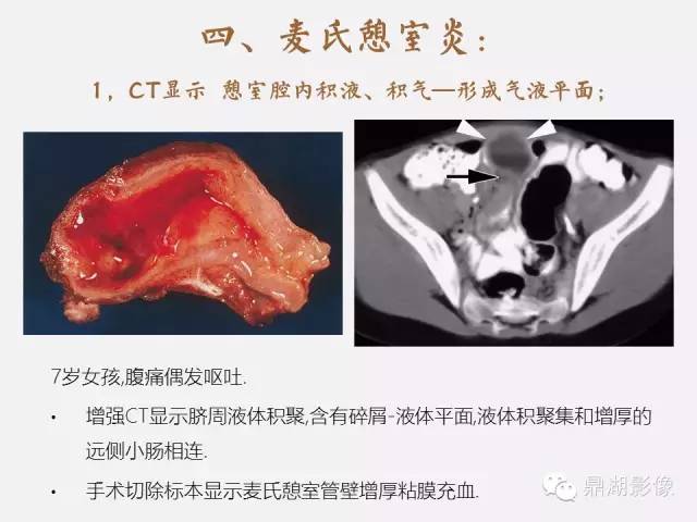 【病例】美克尔憩室(Meckels diverticulum) 一例影像诊断 【病例】美克尔憩室(Meckels diverticulum) 一例影像诊断
