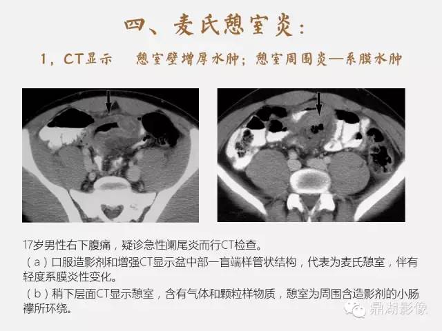 【病例】美克尔憩室(Meckels diverticulum) 一例影像诊断 【病例】美克尔憩室(Meckels diverticulum) 一例影像诊断