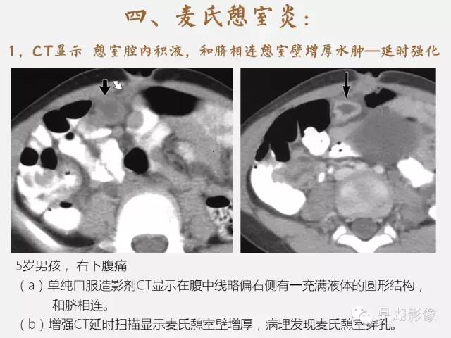 【病例】美克尔憩室(Meckels diverticulum) 一例影像诊断 【病例】美克尔憩室(Meckels diverticulum) 一例影像诊断
