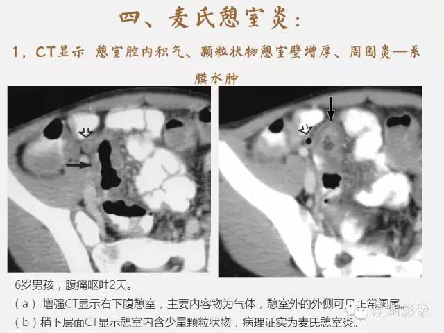 【病例】美克尔憩室(Meckels diverticulum) 一例影像诊断 【病例】美克尔憩室(Meckels diverticulum) 一例影像诊断