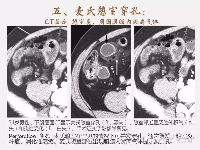 【病例】美克尔憩室(Meckels diverticulum) 一例影像诊断 【病例】美克尔憩室(Meckels diverticulum) 一例影像诊断