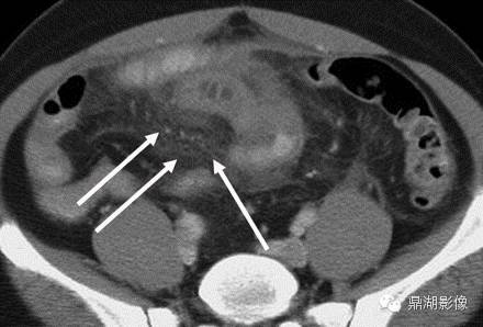 【病例】美克尔憩室(Meckels diverticulum) 一例影像诊断 【病例】美克尔憩室(Meckels diverticulum) 一例影像诊断