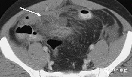 【病例】美克尔憩室(Meckels diverticulum) 一例影像诊断 【病例】美克尔憩室(Meckels diverticulum) 一例影像诊断