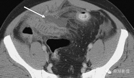 【病例】美克尔憩室(Meckels diverticulum) 一例影像诊断 【病例】美克尔憩室(Meckels diverticulum) 一例影像诊断