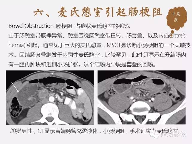 【病例】美克尔憩室(Meckels diverticulum) 一例影像诊断 【病例】美克尔憩室(Meckels diverticulum) 一例影像诊断