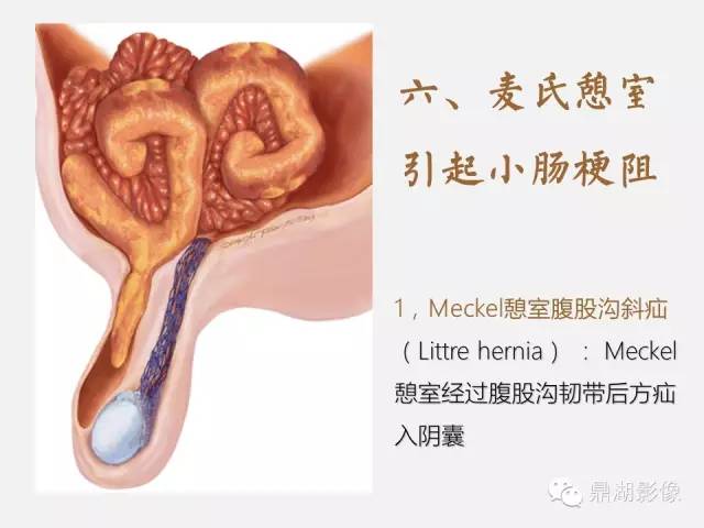 【病例】美克尔憩室(Meckels diverticulum) 一例影像诊断 【病例】美克尔憩室(Meckels diverticulum) 一例影像诊断