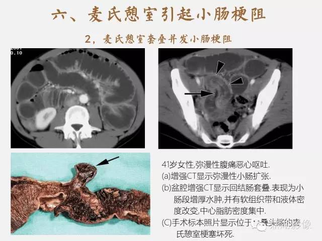 【病例】美克尔憩室(Meckels diverticulum) 一例影像诊断 【病例】美克尔憩室(Meckels diverticulum) 一例影像诊断