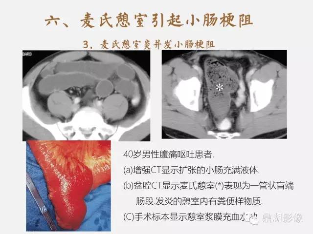 【病例】美克尔憩室(Meckels diverticulum) 一例影像诊断 【病例】美克尔憩室(Meckels diverticulum) 一例影像诊断
