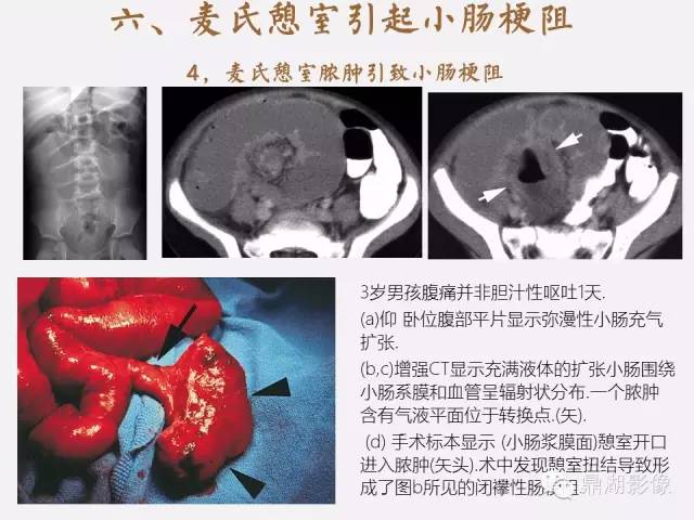 【病例】美克尔憩室(Meckels diverticulum) 一例影像诊断 【病例】美克尔憩室(Meckels diverticulum) 一例影像诊断