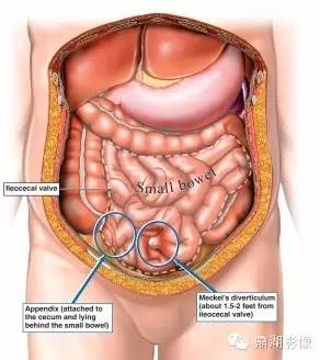 【病例】美克尔憩室(Meckels diverticulum) 一例影像诊断 【病例】美克尔憩室(Meckels diverticulum) 一例影像诊断