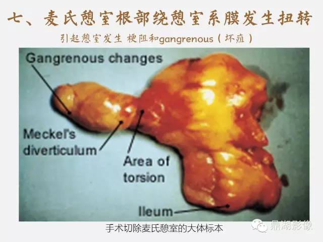 【病例】美克尔憩室(Meckels diverticulum) 一例影像诊断 【病例】美克尔憩室(Meckels diverticulum) 一例影像诊断