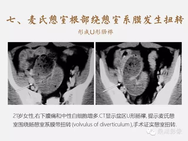 【病例】美克尔憩室(Meckels diverticulum) 一例影像诊断 【病例】美克尔憩室(Meckels diverticulum) 一例影像诊断