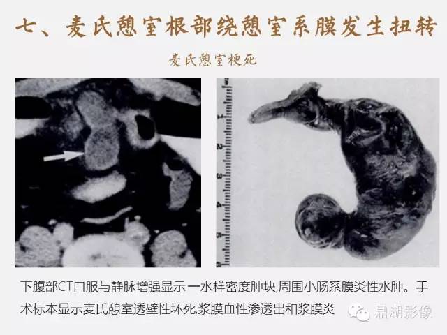 【病例】美克尔憩室(Meckels diverticulum) 一例影像诊断 【病例】美克尔憩室(Meckels diverticulum) 一例影像诊断