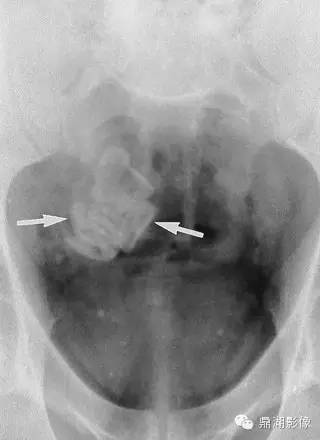 【病例】美克尔憩室(Meckels diverticulum) 一例影像诊断 【病例】美克尔憩室(Meckels diverticulum) 一例影像诊断