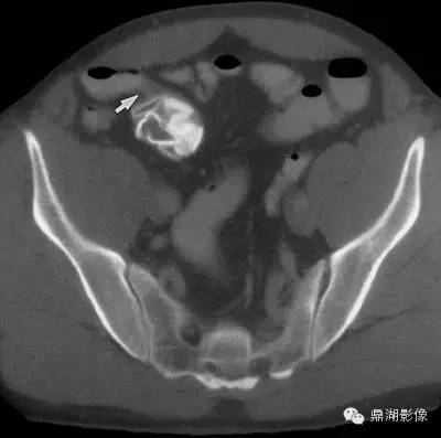 【病例】美克尔憩室(Meckels diverticulum) 一例影像诊断 【病例】美克尔憩室(Meckels diverticulum) 一例影像诊断