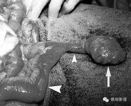 【病例】美克尔憩室(Meckels diverticulum) 一例影像诊断 【病例】美克尔憩室(Meckels diverticulum) 一例影像诊断