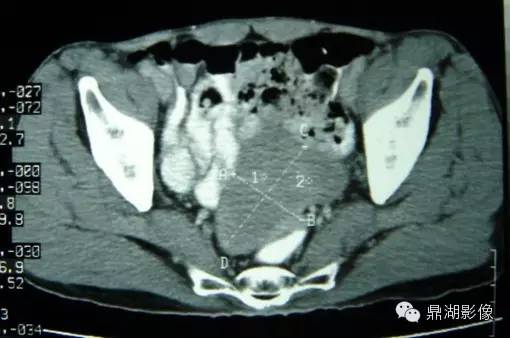 【病例】美克尔憩室(Meckels diverticulum) 一例影像诊断 【病例】美克尔憩室(Meckels diverticulum) 一例影像诊断