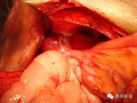 【病例】美克尔憩室(Meckels diverticulum) 一例影像诊断 【病例】美克尔憩室(Meckels diverticulum) 一例影像诊断