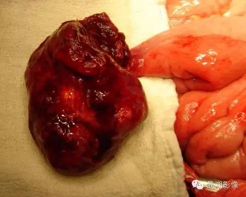 【病例】美克尔憩室(Meckels diverticulum) 一例影像诊断 【病例】美克尔憩室(Meckels diverticulum) 一例影像诊断