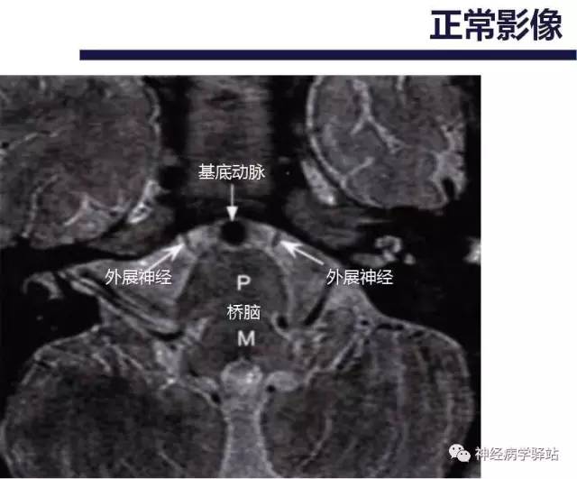 【PPT】展神经解剖、影像及临床