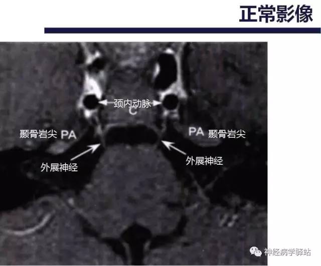 【PPT】展神经解剖、影像及临床