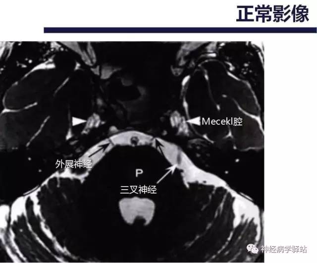 【PPT】展神经解剖、影像及临床