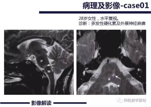 【PPT】展神经解剖、影像及临床