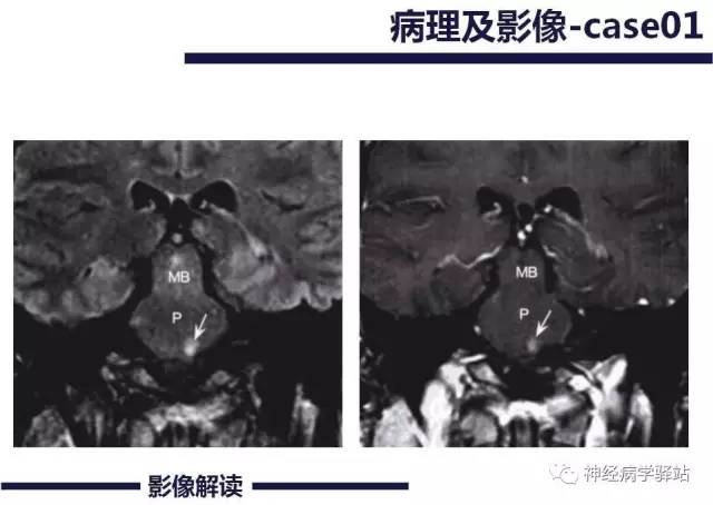 【PPT】展神经解剖、影像及临床