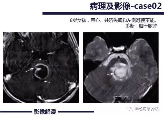 【PPT】展神经解剖、影像及临床
