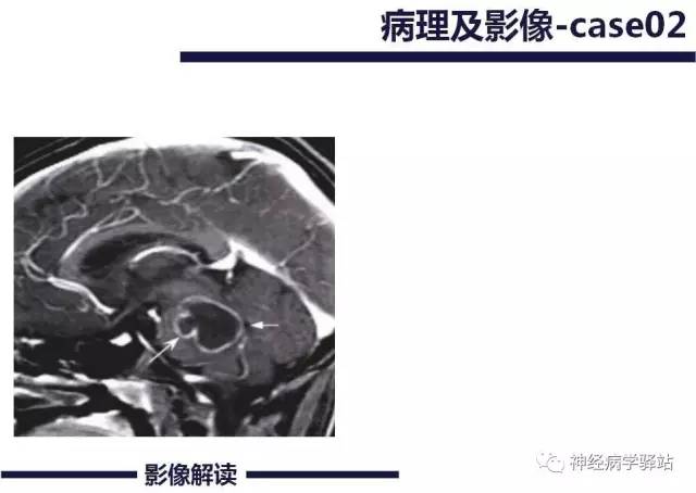 【PPT】展神经解剖、影像及临床