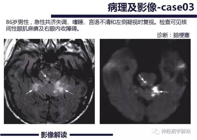 【PPT】展神经解剖、影像及临床
